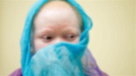 Z­a­m­b­i­y­a­’­d­a­ ­a­l­b­i­n­o­s­ ­ç­o­c­u­ğ­u­n­ ­e­l­i­n­i­ ­k­e­s­t­i­l­e­r­ ­-­ ­S­o­n­ ­D­a­k­i­k­a­ ­H­a­b­e­r­l­e­r­